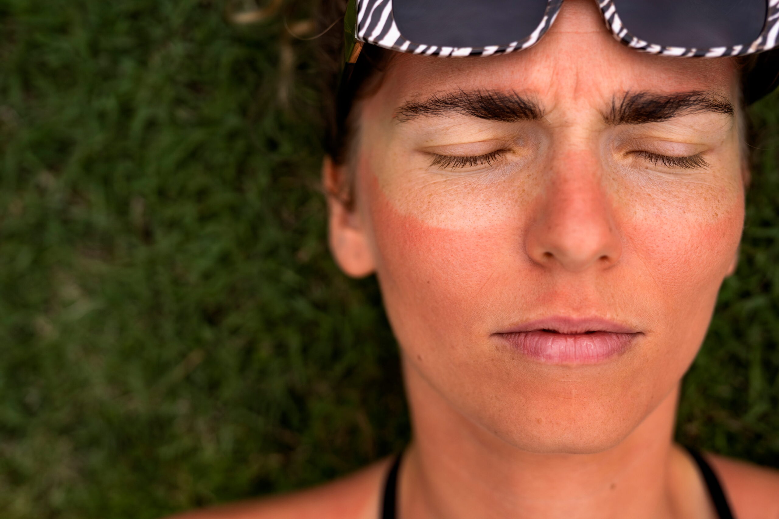 An adult woman with sunburned skin
